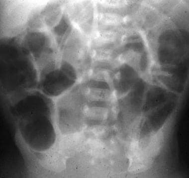 Increasing pneumatosis intestinalis is seen in thi