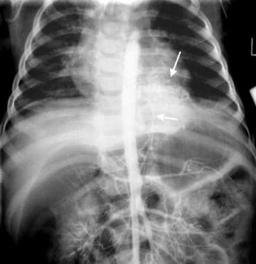 Intralobar pulmonary sequestration. Aortogram in a