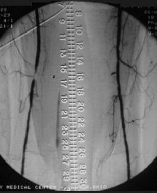 Digital subtraction angiogram (DSA) illustrates a 