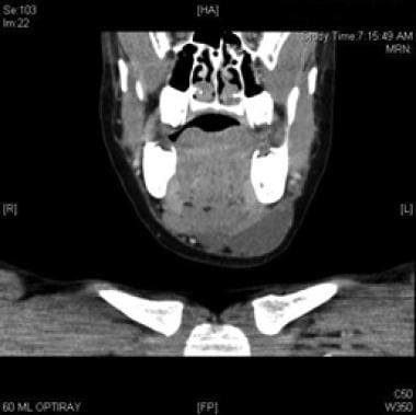 Coronal CT scan with contrast of macrocystic lymph
