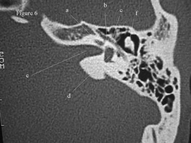 CT scan, temporal bone. The basal turn of the coch