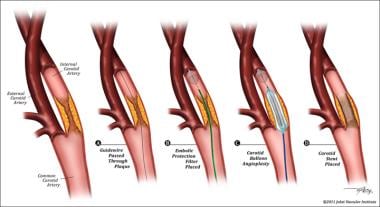 Carotid Artery Stenting Technique: Approach Considerations ...