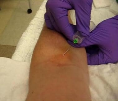 Phlebotomy. Insertion of needle (bevel up).