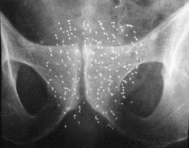 Brachytherapy for prostate cancer. Abdominal radio