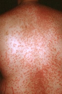 Allergic reaction to minocycline hives