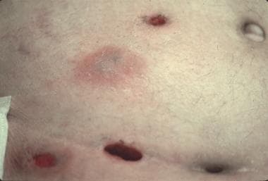 Violaceous plaques and necrotic ulcers on the abdo