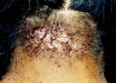 Numerous acne keloidalis papules and plaques in a 