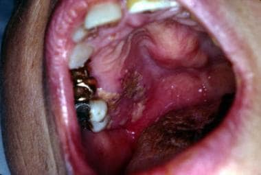 Aspergillosis. Note deep mucosal ulceration and no