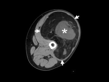 计算机断层扫描(CT)显示左大腿