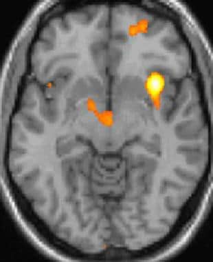 Cluster headache: Functional imaging shows activat