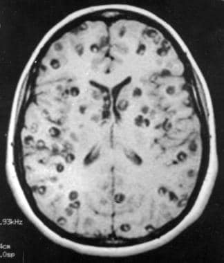 Massive nonencephalitic neurocysticercosis. Photo 