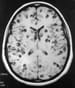 Neurocysticercosis