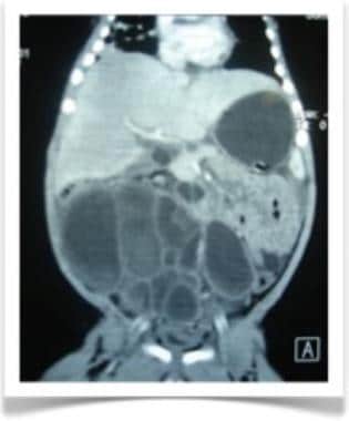 Coronal CT image of abdomen in 2-year-old patient 
