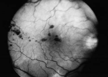 An impending bilateral central retinal vein obstru