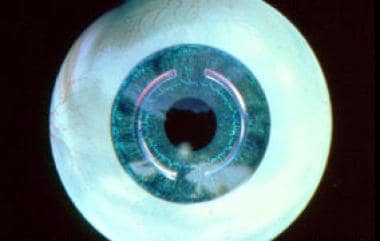 Graphic representation of the intracorneal ring se