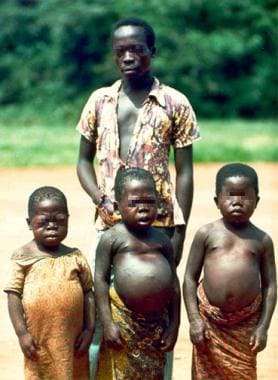 Iodine Deficiency. A man and 3 females (age range,