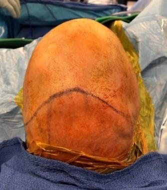 Preoperative view of sagittal craniosynostosis wit