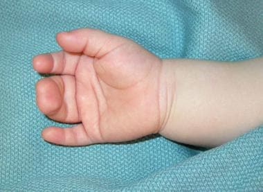 Palmar view of hand of 1-year-old child with compl