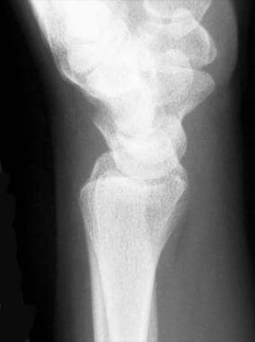 Lateral radiograph of normal wrist. 