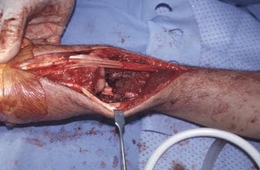 Intraoperative photograph of resection bed of same