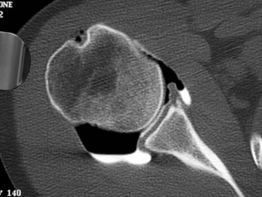 Computed tomography (CT) arthrogram of a shoulder 
