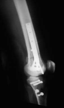 Supracondylar femur fracture treated with a tibial