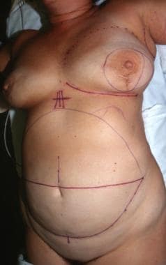 Patient 3. Preoperative markings. The patient has 