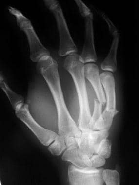 Fourth and fifth metacarpal fractures, oblique vie