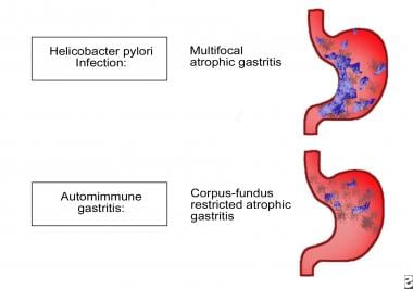 Patterns of atrophic gastritis associated with chr