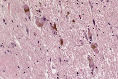 Lewy bodies in the locus coeruleus from a patient