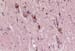 Parkinson Disease