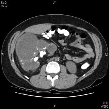 xanthogranulomatous pyelonephritis ultrasound