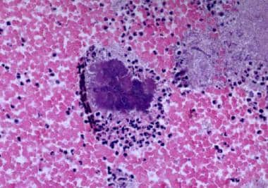Actinomycosis in the endometrial tissue, low-power