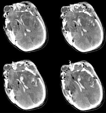 CT scan of bilateral acute intraventricular hemorr