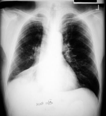 Right Middle Lobe Collapse X Ray