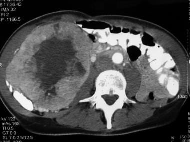 CT finding that confirms a huge right renal mass. 