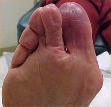Cyanosis of first toe and dependent rubor of foot,