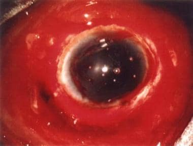 Operating microscope view of a globe rupture secon