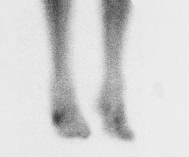 Bone scan of the lower extremities. This image dep