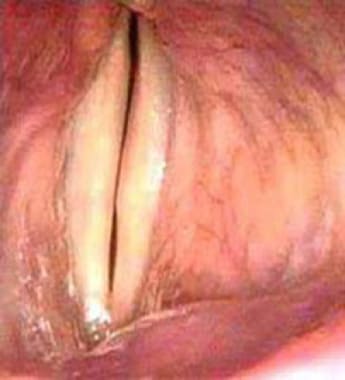 Postoperatively, the image shows the same vocal fo