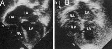 Ventricular Septal Defects. Apical four-chamber vi