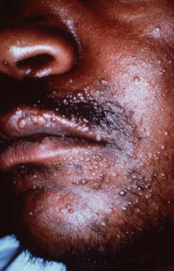 Multiple papules on the face of a man with HIV. 