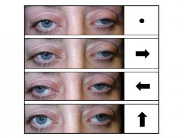 Bilateral ptosis and external ophthalmoplegia. Top