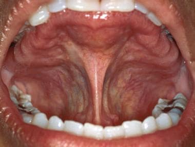 The lingual frenum is the primary soft tissue atta