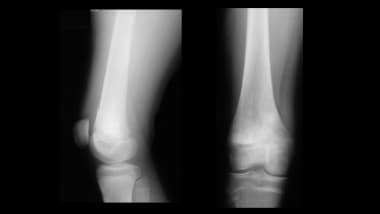 Growth plate (physeal) fractures. Healed Salter-Ha