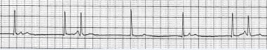 Atrioventricular Dissociation. This rhythm strip r