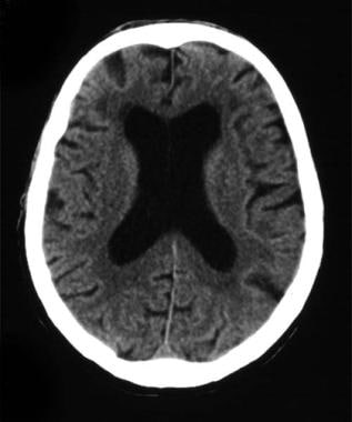CT scan of a 62-year-old man with Down syndrome co