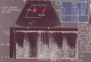 High-grade stenosis as seen on spectral analysis. 