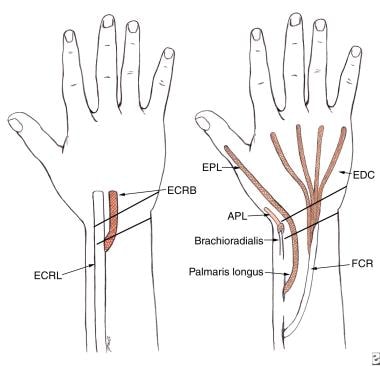 Low radial nerve palsy. Extensor carpi radialis br