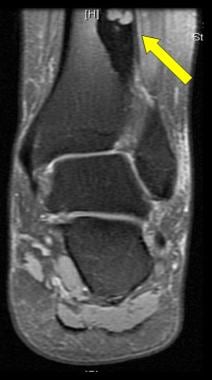 MRI shows osteoid osteoma. Courtesy of Cincinnati 
